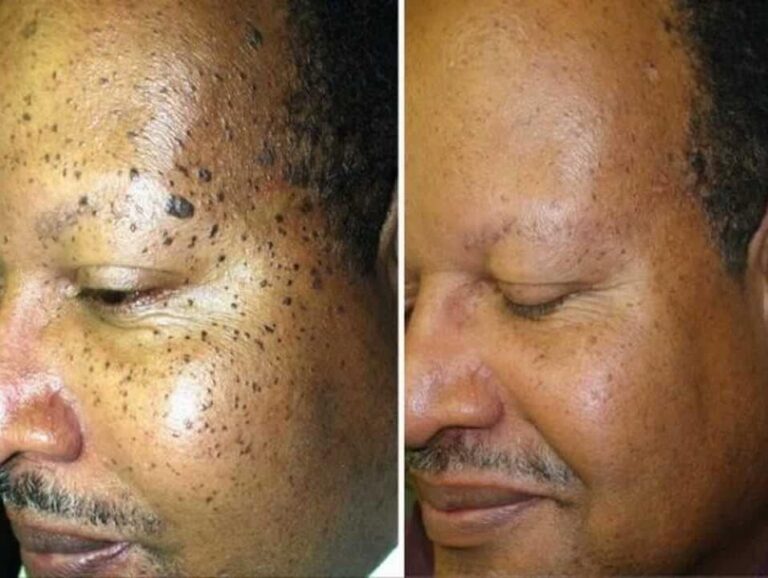 skin-tags-moles-warts-removall-before-and-after-768x578 (1)